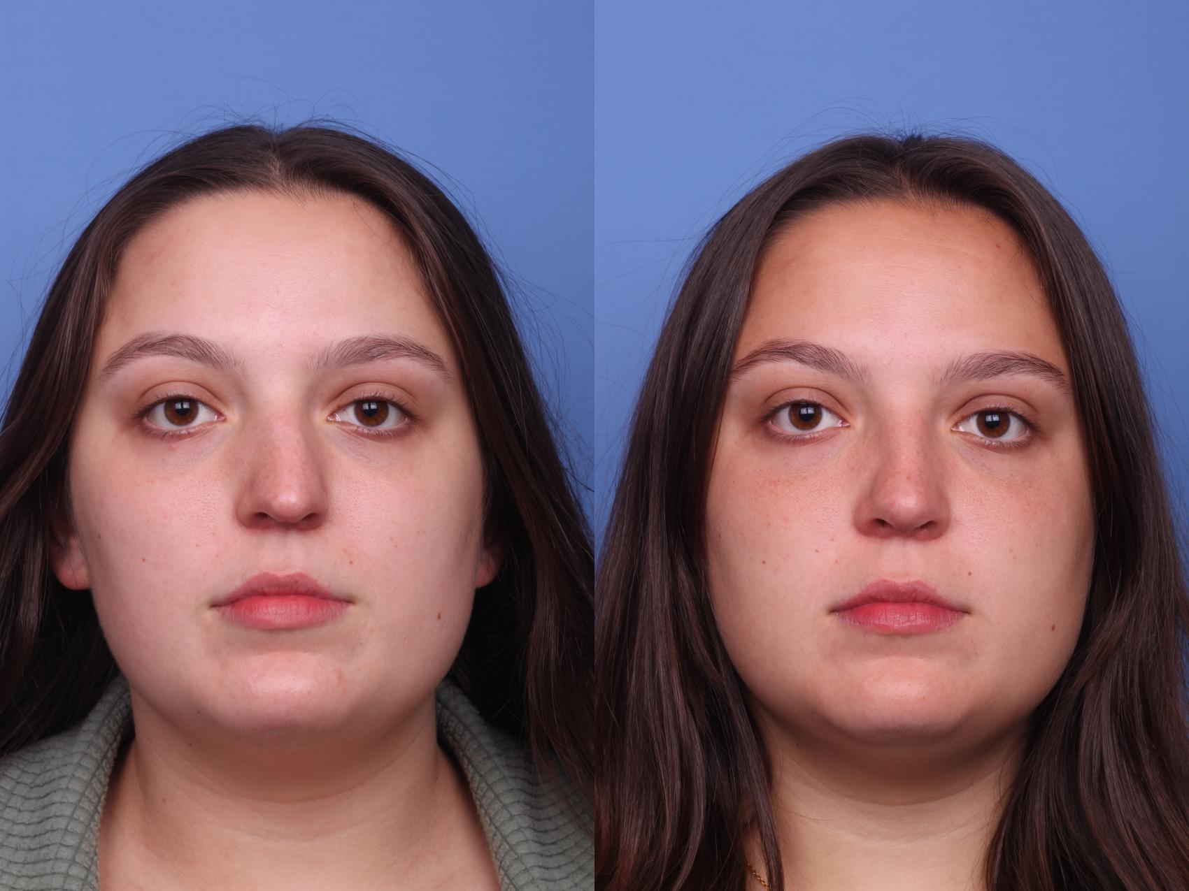 Before & After Rhinoplasty Case 416 Front View in Scottsdale, AZ