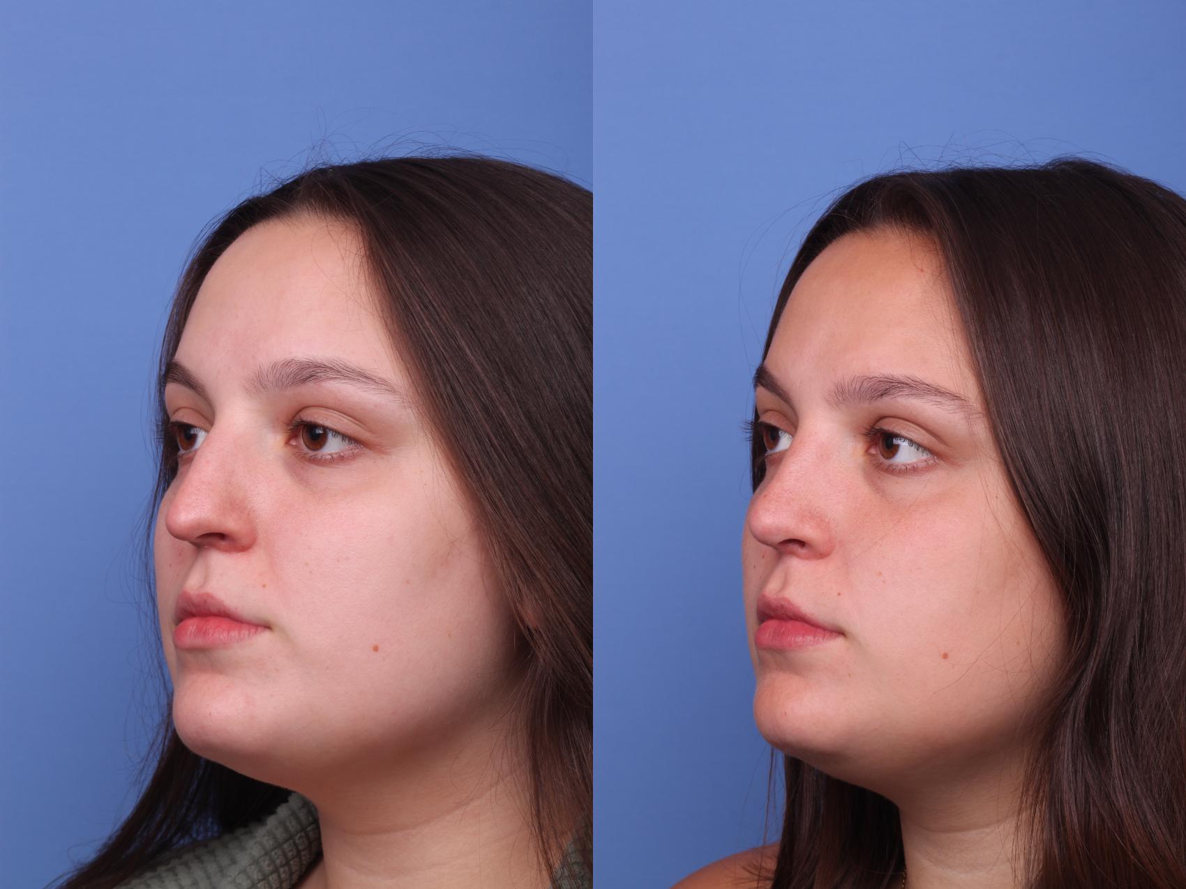 Before & After Rhinoplasty Case 416 Left Oblique View in Scottsdale, AZ