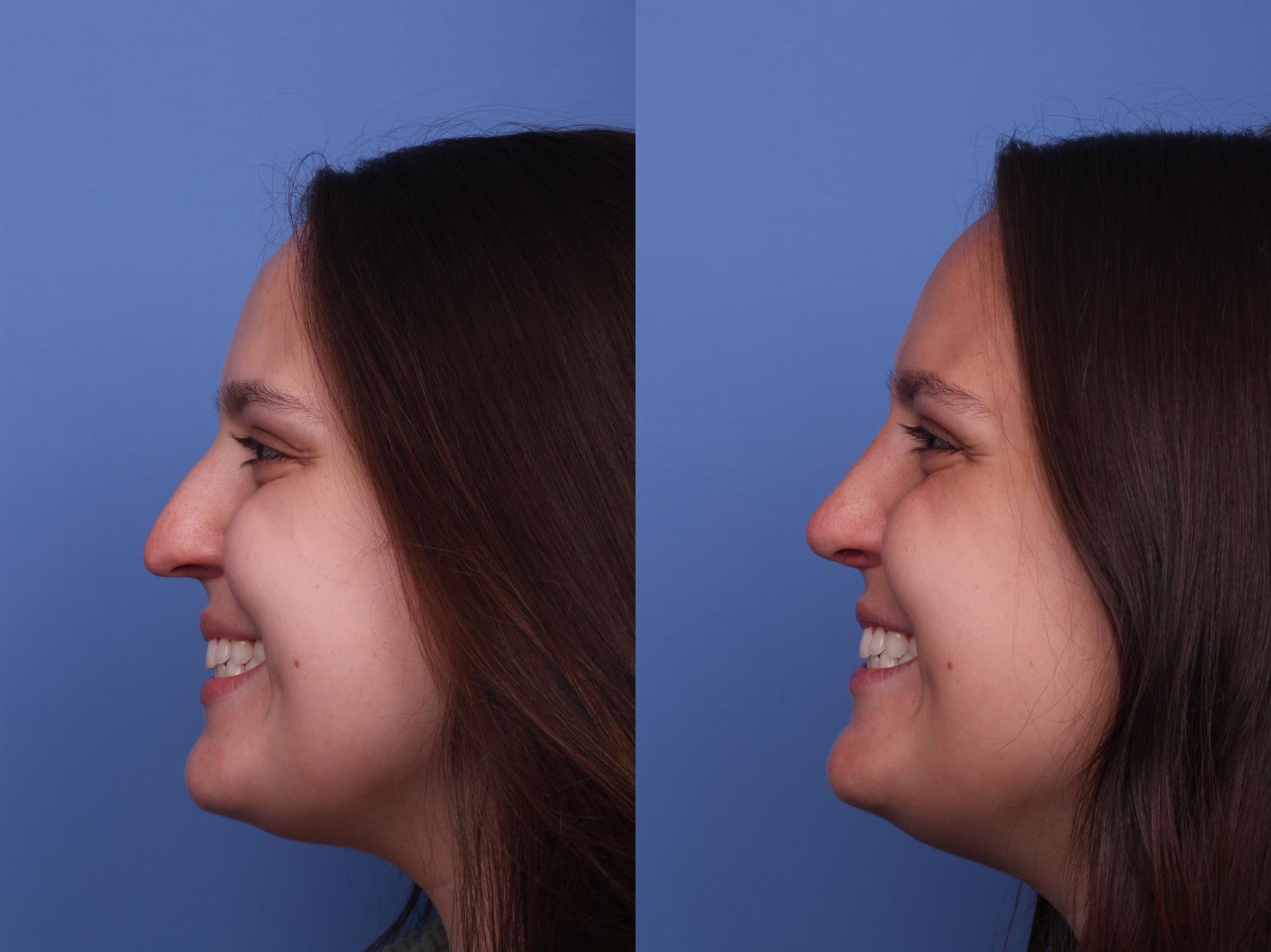 Before & After Rhinoplasty Case 416 Left Smile View in Scottsdale, AZ