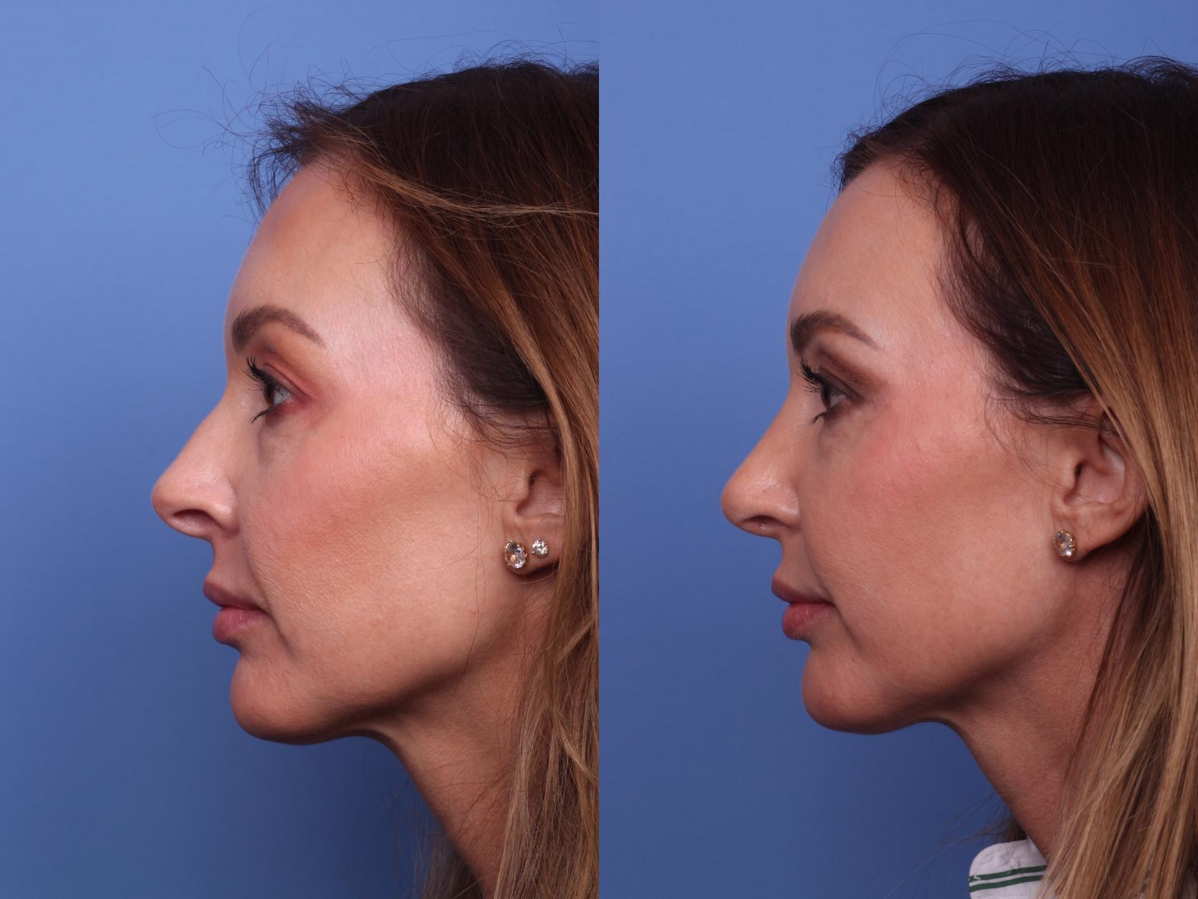 Before & After Rhinoplasty Case 417 Left Side View in Scottsdale, AZ