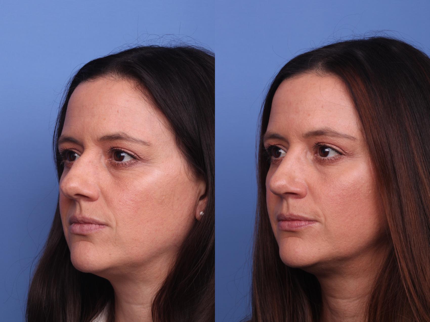 Before & After Rhinoplasty Case 420 Left Oblique View in Scottsdale, AZ