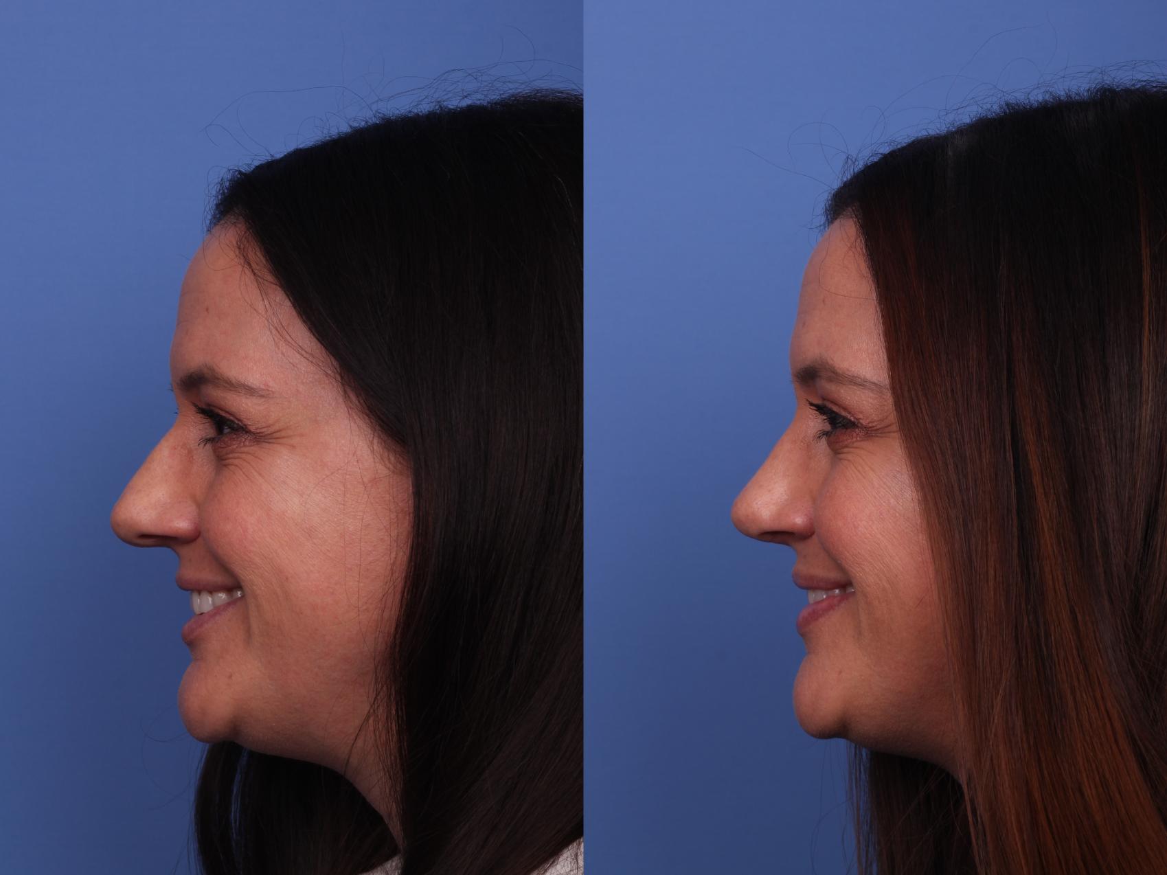 Before & After Rhinoplasty Case 420 Left Smile View in Scottsdale, AZ