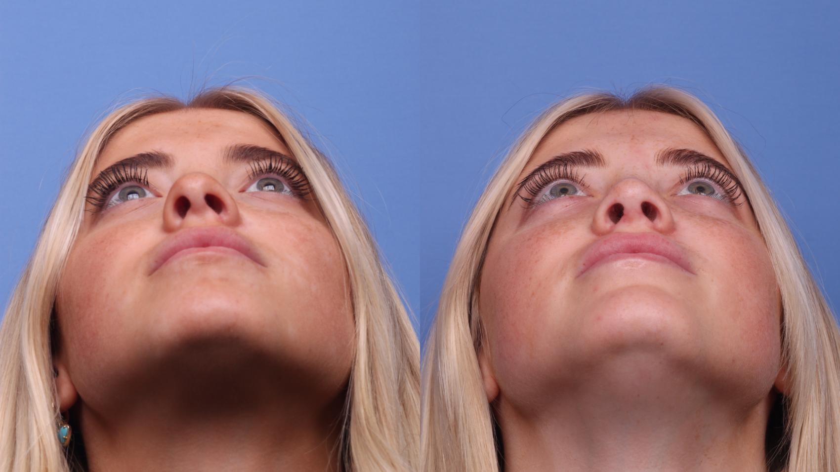 Before & After Rhinoplasty Case 421 Base View in Scottsdale, AZ