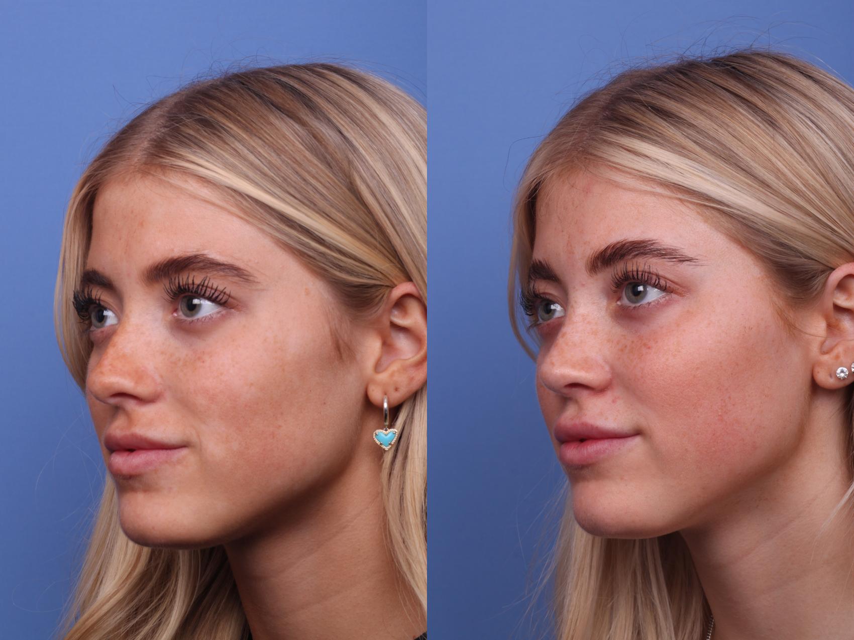 Before & After Rhinoplasty Case 421 Left Oblique View in Scottsdale, AZ