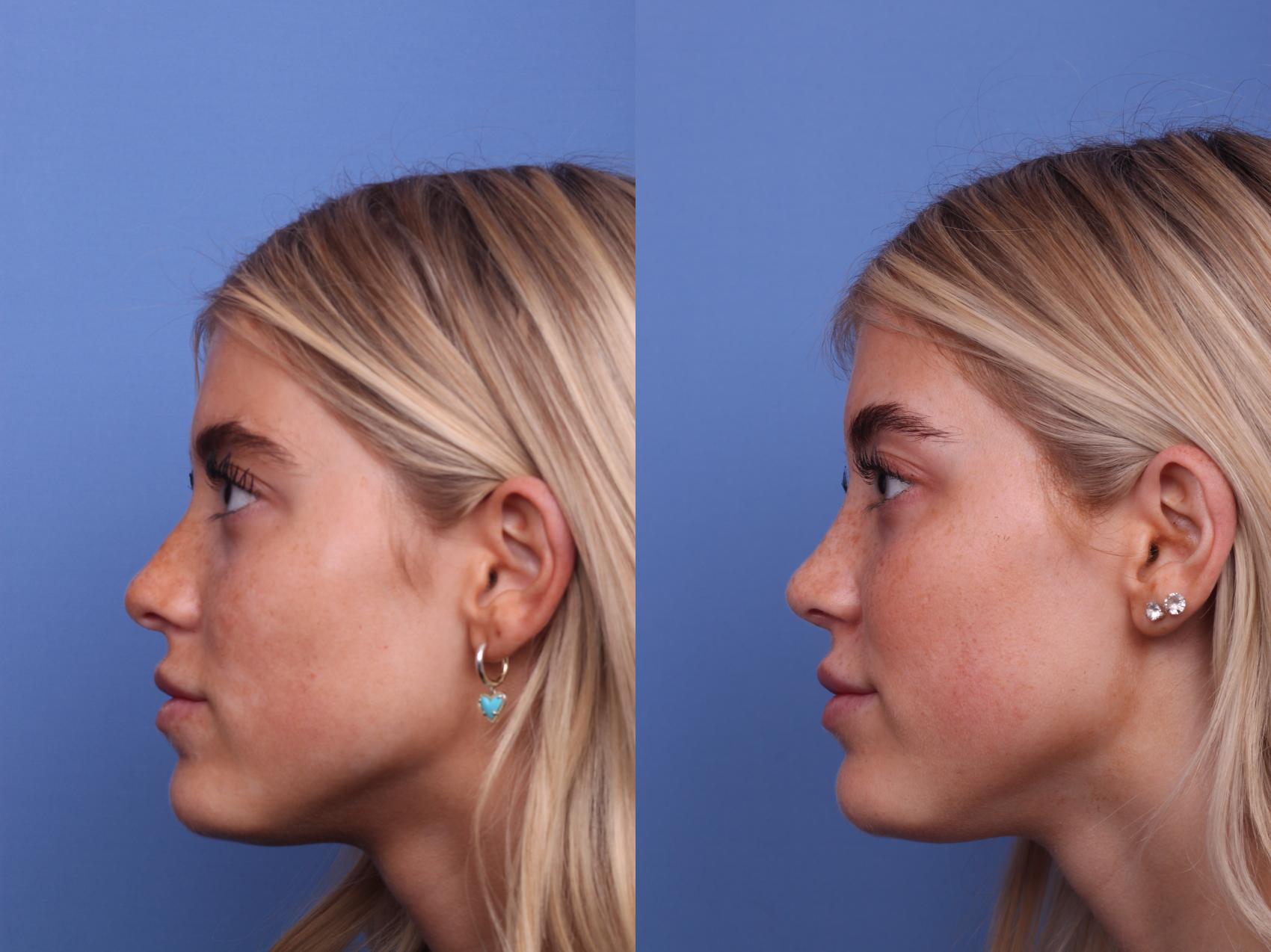 Before & After Rhinoplasty Case 421 Left Side View in Scottsdale, AZ