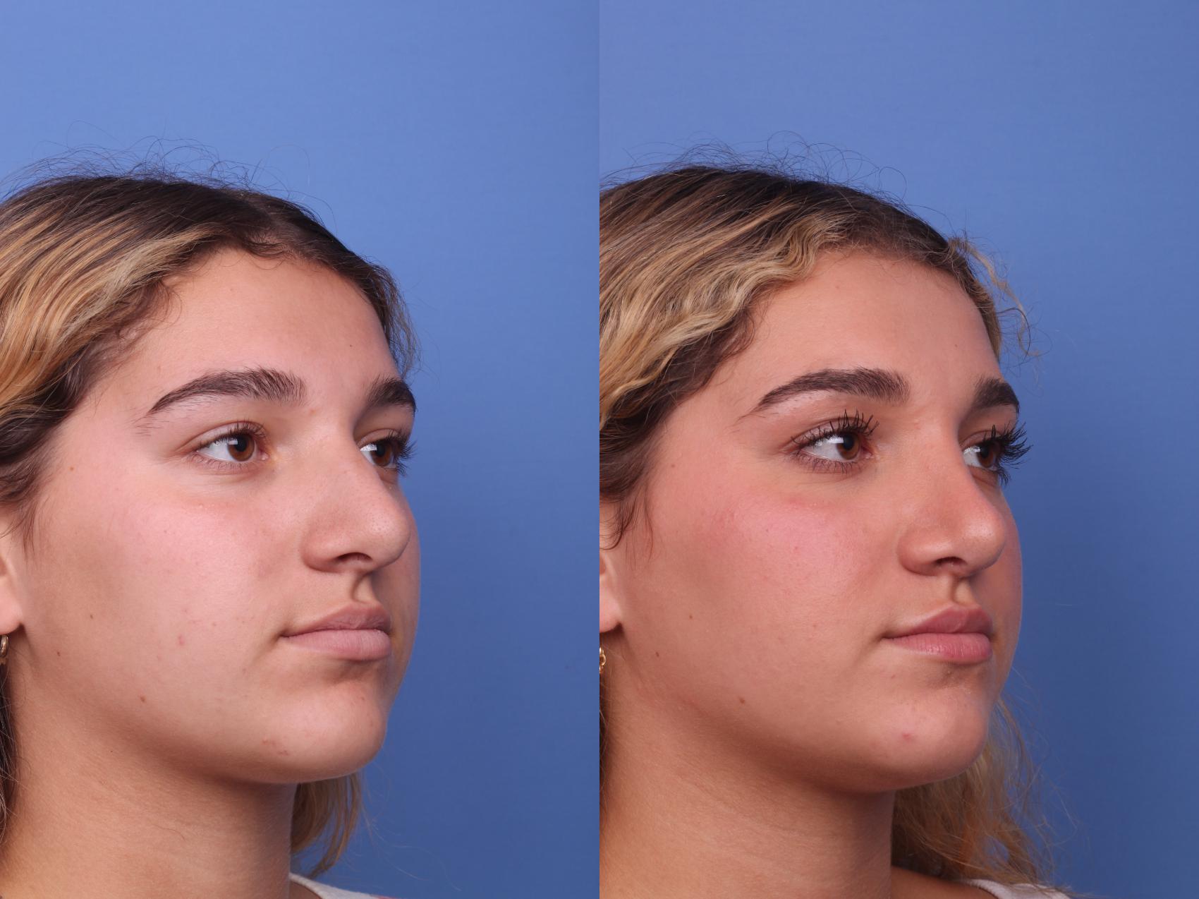 Before & After Rhinoplasty Case 422 Right Oblique View in Scottsdale, AZ
