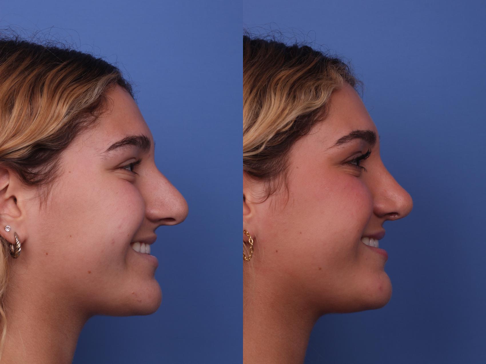 Before & After Rhinoplasty Case 422 Right Smile View in Scottsdale, AZ