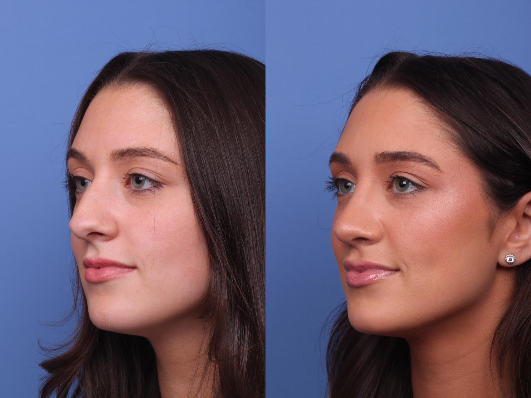 Before & After Rhinoplasty Case 423 Left Oblique View in Scottsdale, AZ