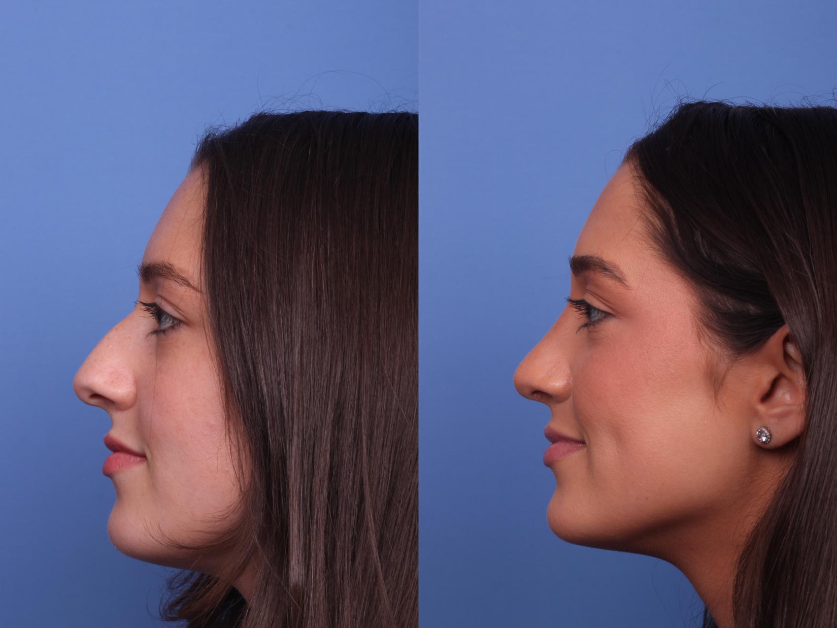 Rhinoplasty Before & After Photo | Scottsdale & Phoenix, AZ | Hobgood Facial Plastic Surgery: Todd Hobgood, MD