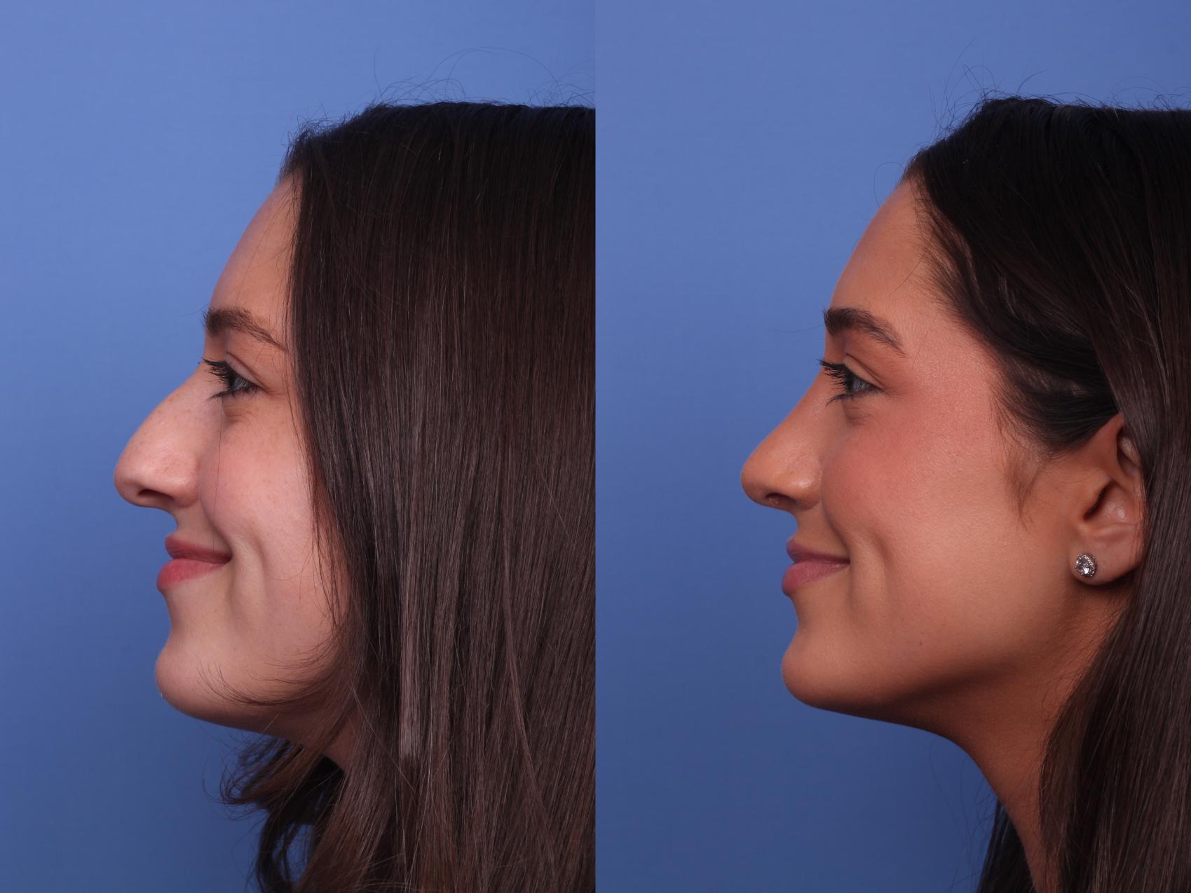 Before & After Rhinoplasty Case 423 Left Smile View in Scottsdale, AZ