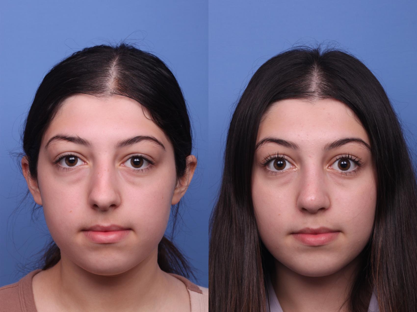 Before & After Rhinoplasty Case 424 Front View in Scottsdale, AZ