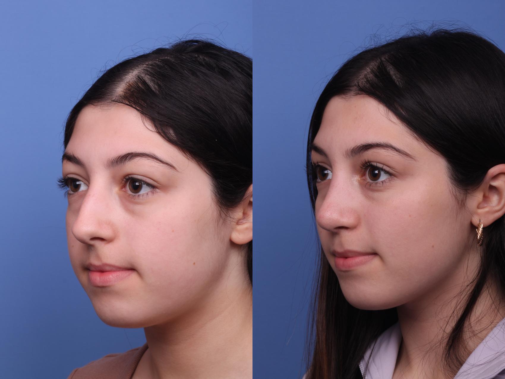 Before & After Rhinoplasty Case 424 Left Oblique View in Scottsdale, AZ