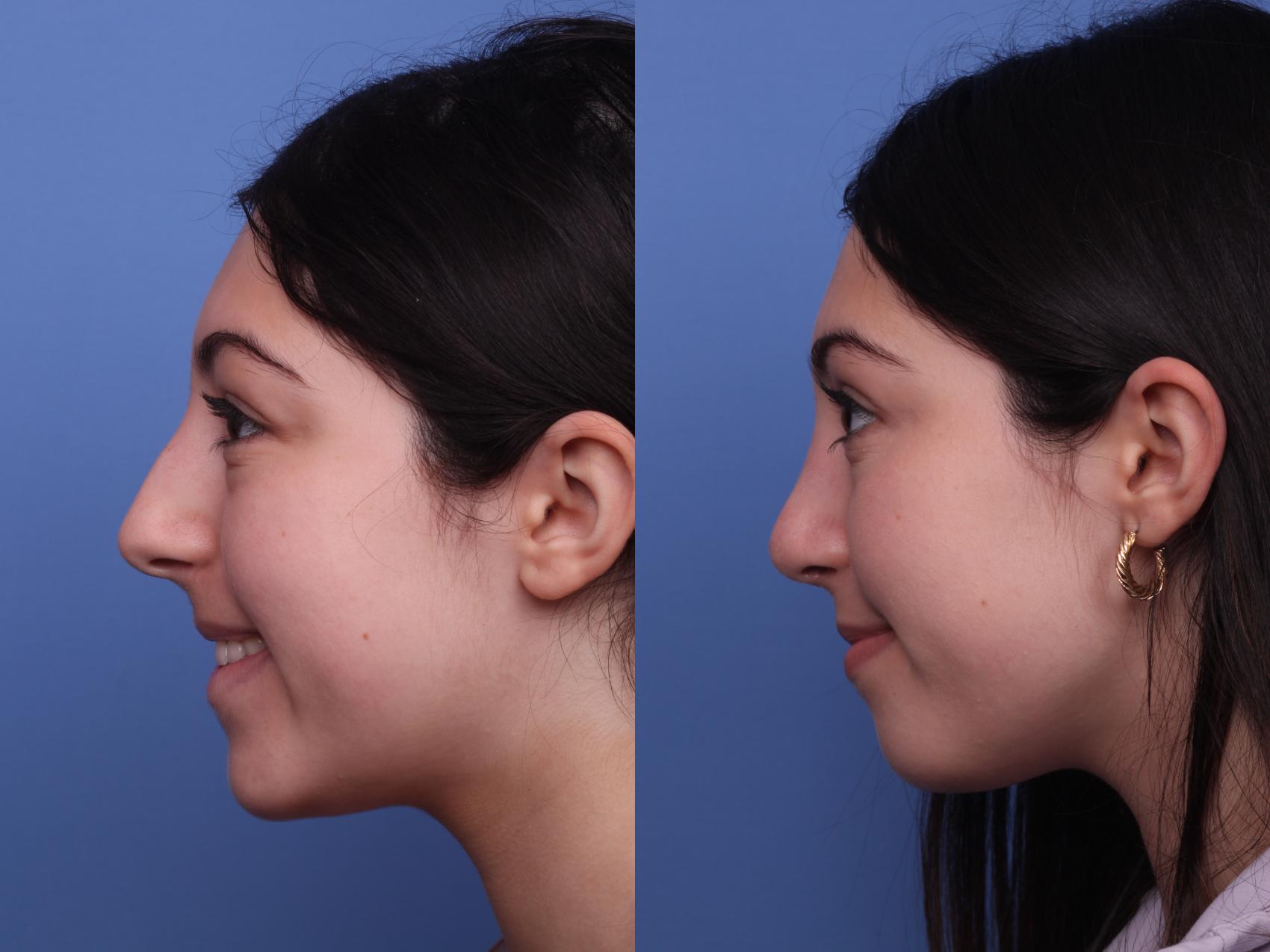 Before & After Rhinoplasty Case 424 Left Smile View in Scottsdale, AZ