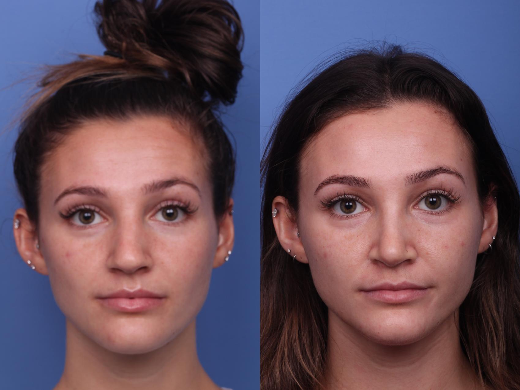 Before & After Rhinoplasty Case 425 Front View in Scottsdale, AZ