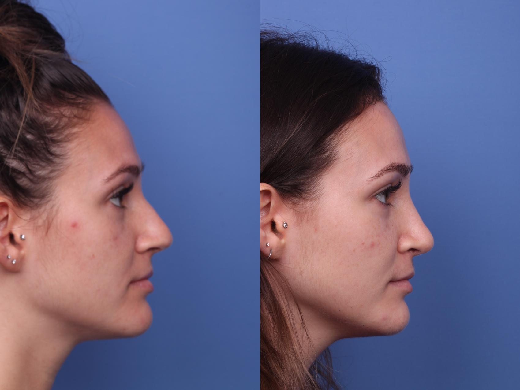 Before & After Rhinoplasty Case 425 Right Side View in Scottsdale, AZ