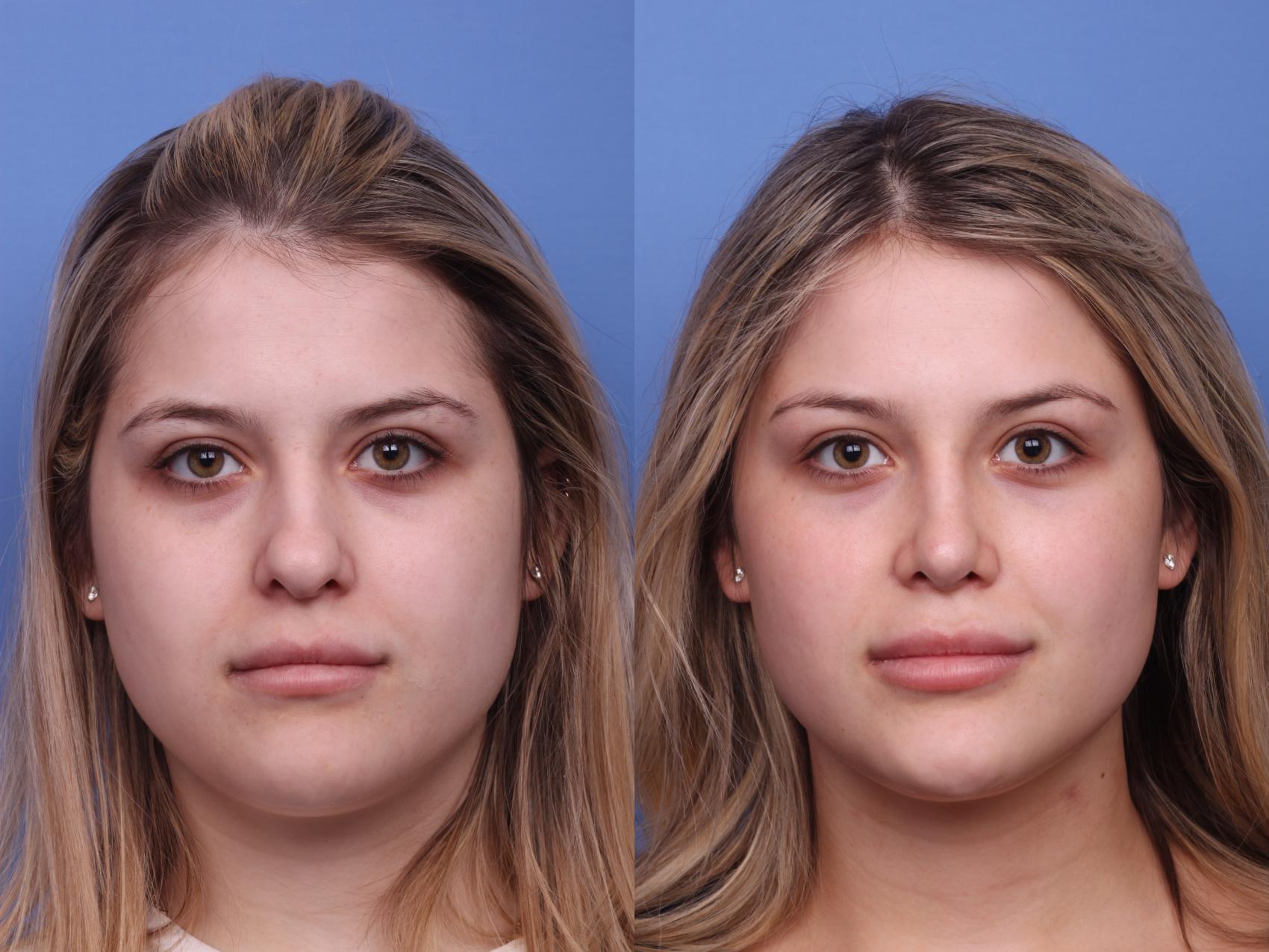 Before & After Rhinoplasty Case 426 Front View in Scottsdale, AZ