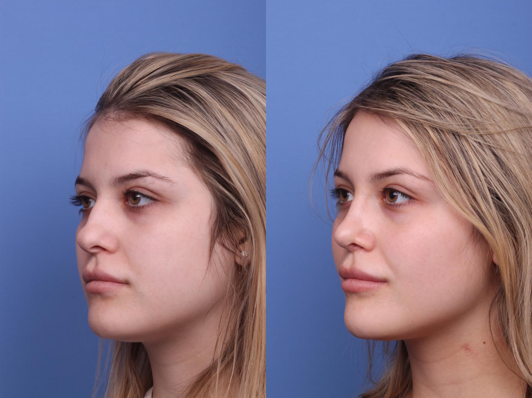 Before & After Rhinoplasty Case 426 Left Oblique View in Scottsdale, AZ