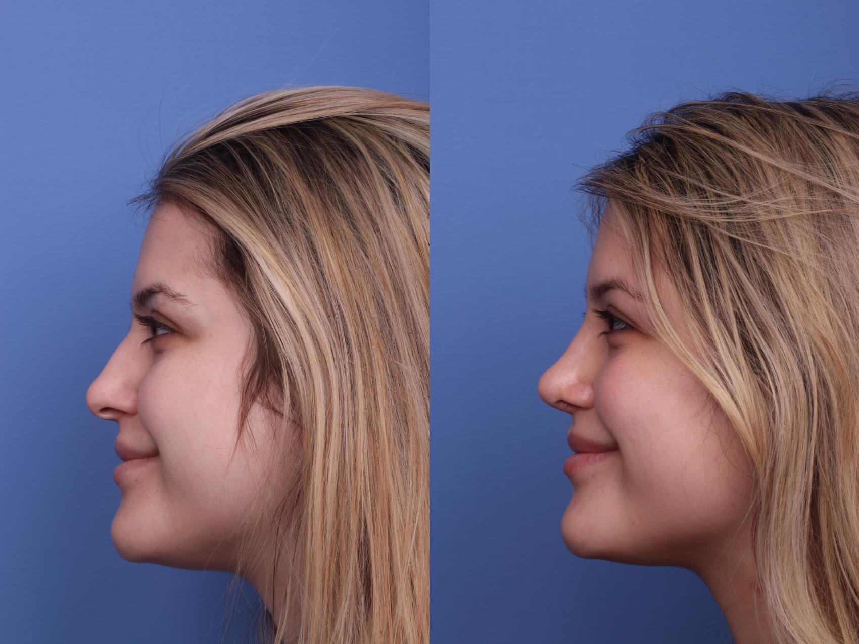 Before & After Rhinoplasty Case 426 Left Smile View in Scottsdale, AZ