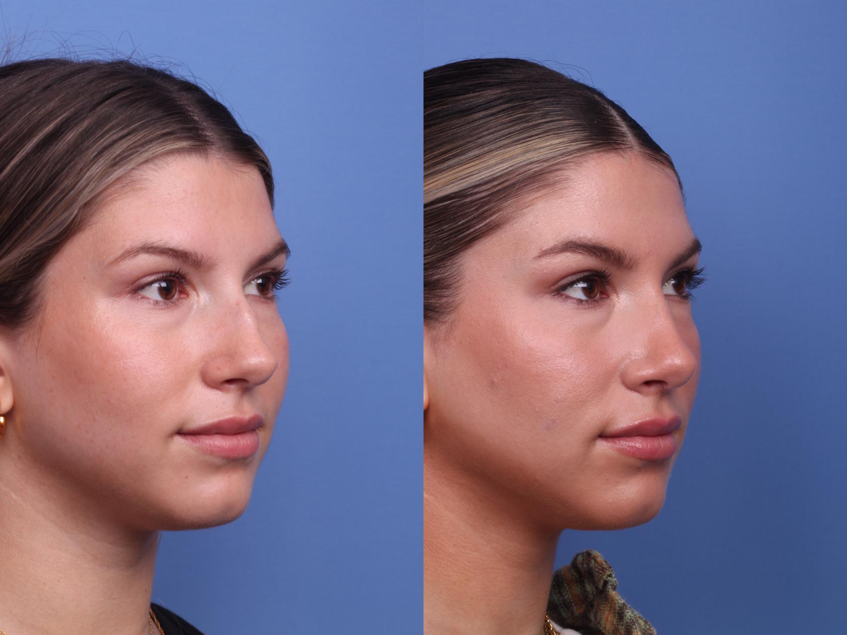 Before & After Rhinoplasty Case 427 Right Oblique View in Scottsdale, AZ