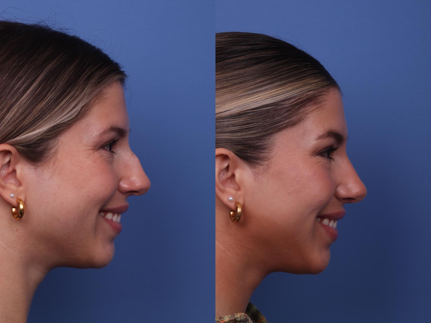 Before & After Rhinoplasty Case 427 Right Smile View in Scottsdale, AZ