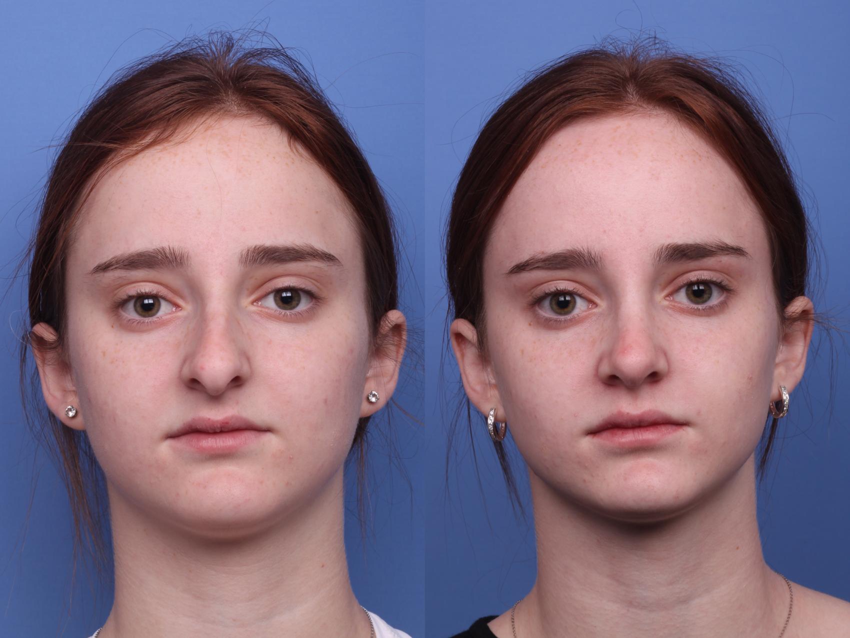 Before & After Rhinoplasty Case 428 Front View in Scottsdale, AZ