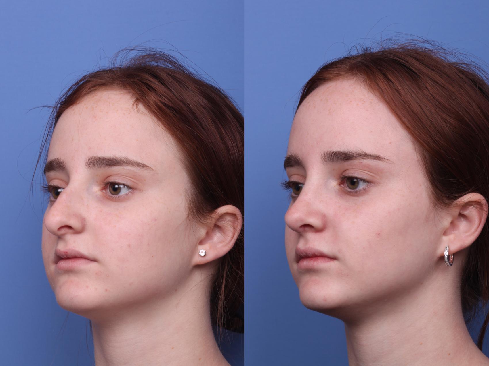 Before & After Rhinoplasty Case 428 Left Oblique View in Scottsdale, AZ