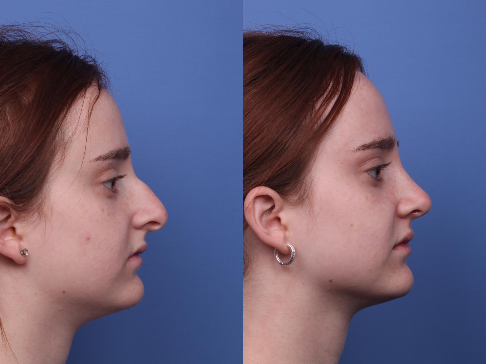 Before & After Rhinoplasty Case 428 Right Side View in Scottsdale, AZ