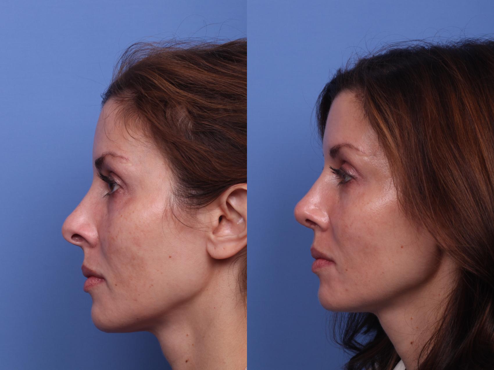 Before & After Rhinoplasty Case 430 Left Side View in Scottsdale, AZ