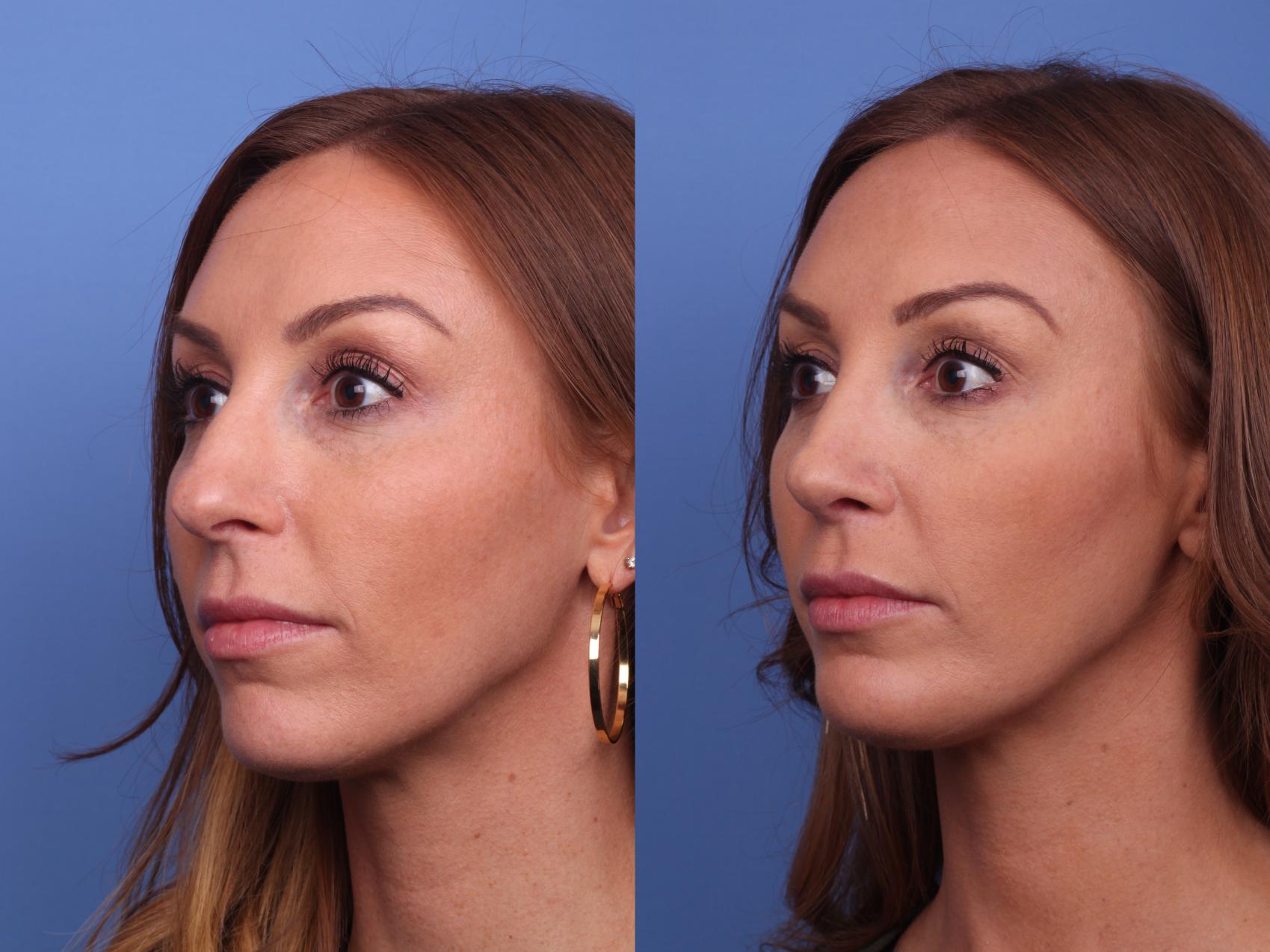 Before & After Rhinoplasty Case 432 Left Oblique View in Scottsdale, AZ