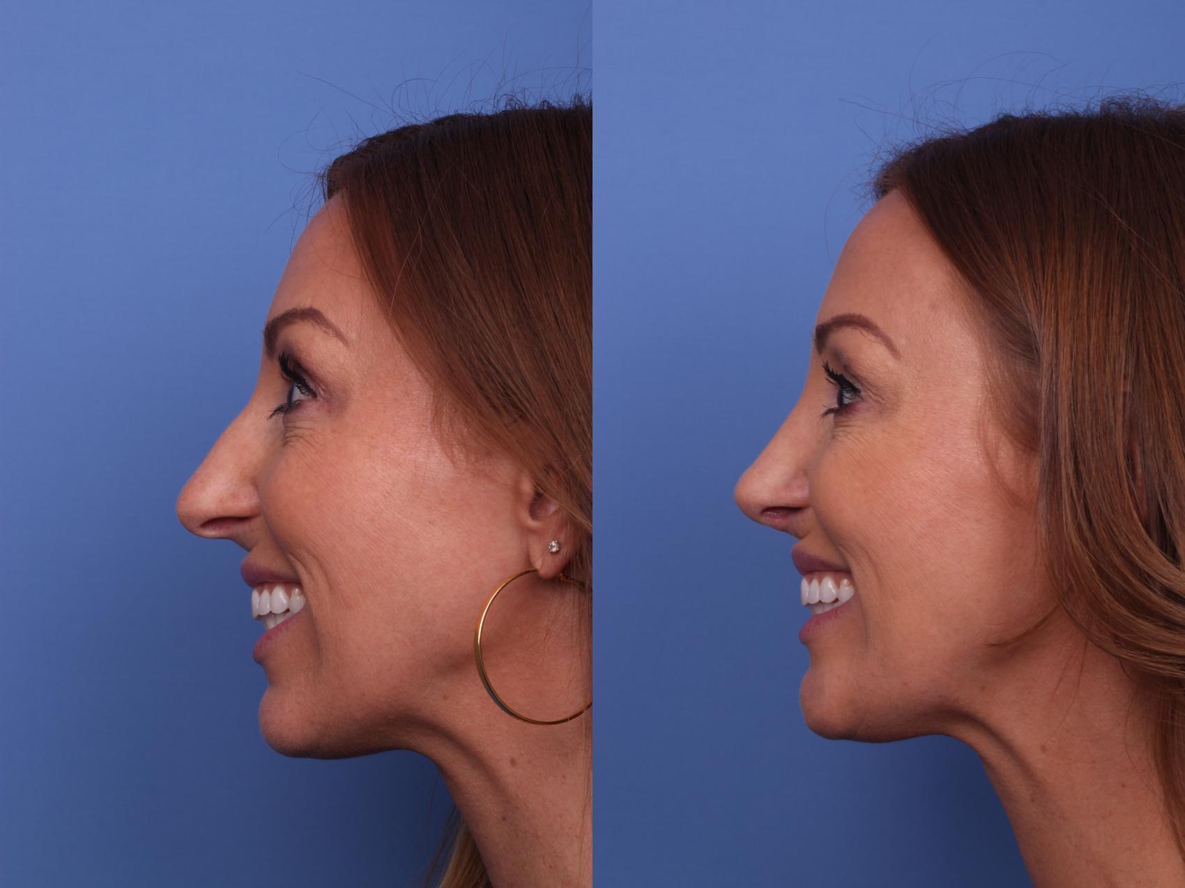 Before & After Rhinoplasty Case 432 Left Smile View in Scottsdale, AZ