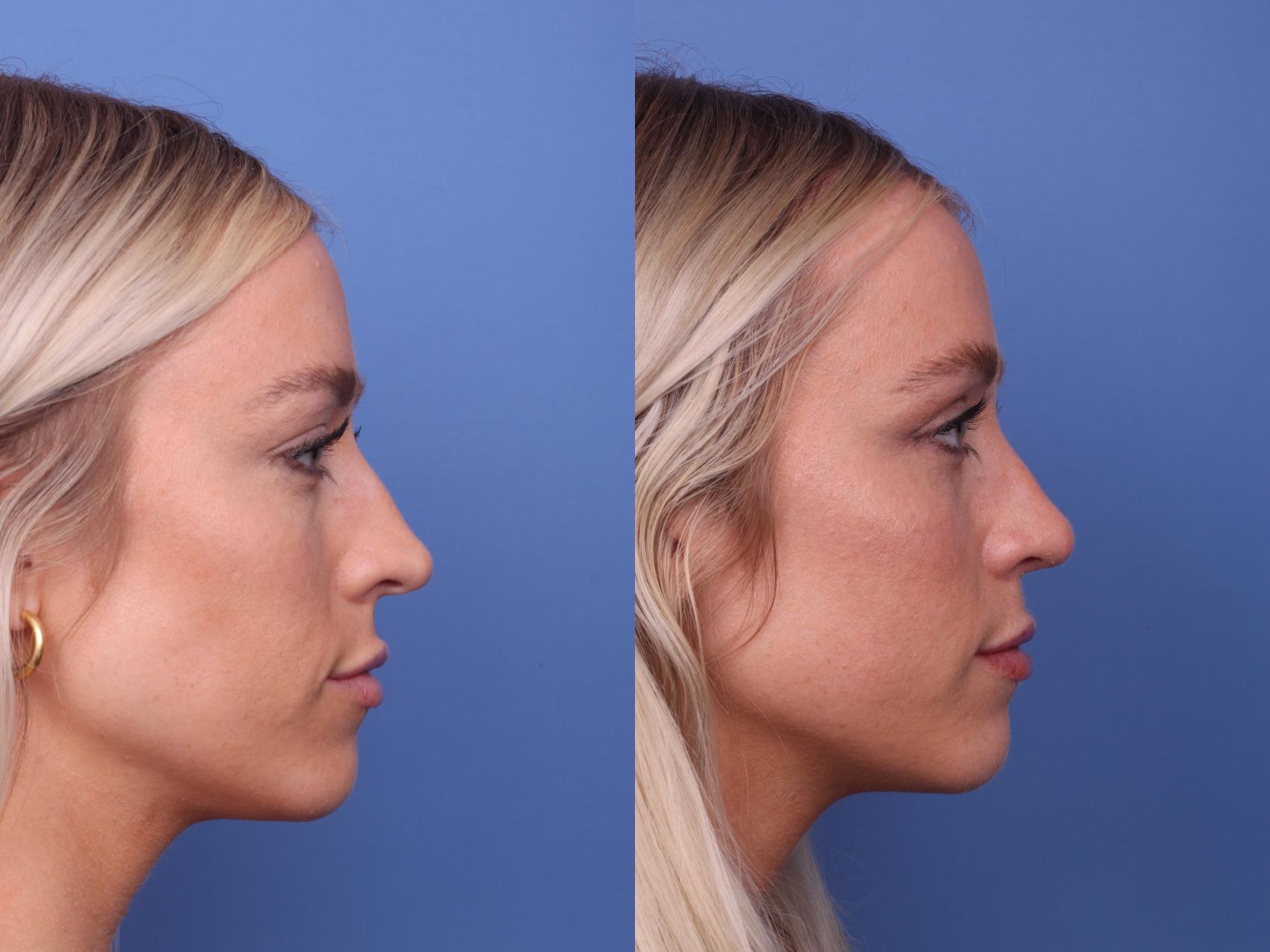 Before & After Rhinoplasty Case 434 Right Side View in Scottsdale, AZ