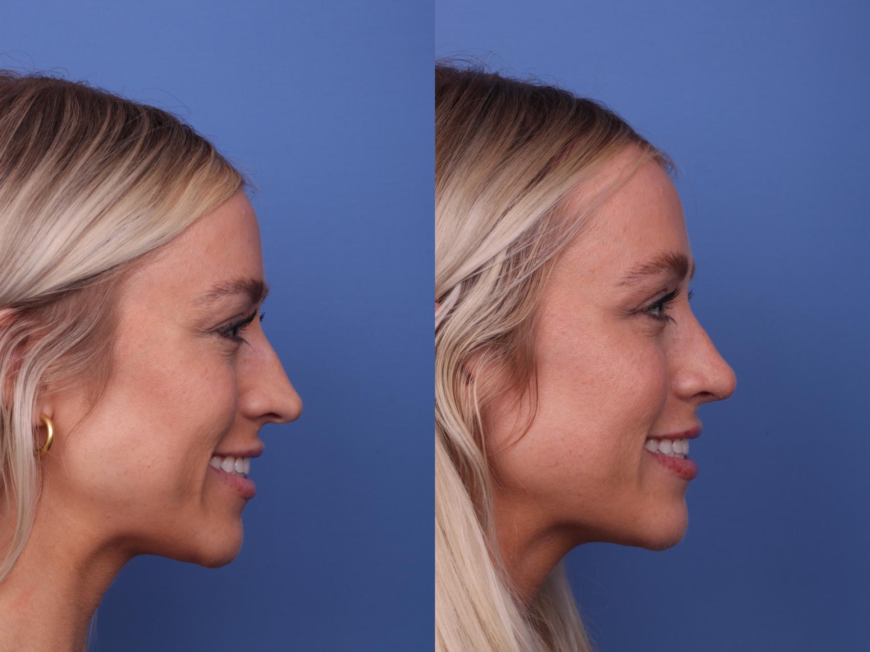 Before & After Rhinoplasty Case 434 Right Smile View in Scottsdale, AZ