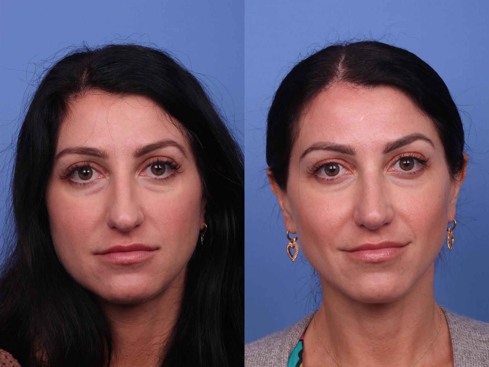 Before & After Rhinoplasty Case 435 Front View in Scottsdale, AZ