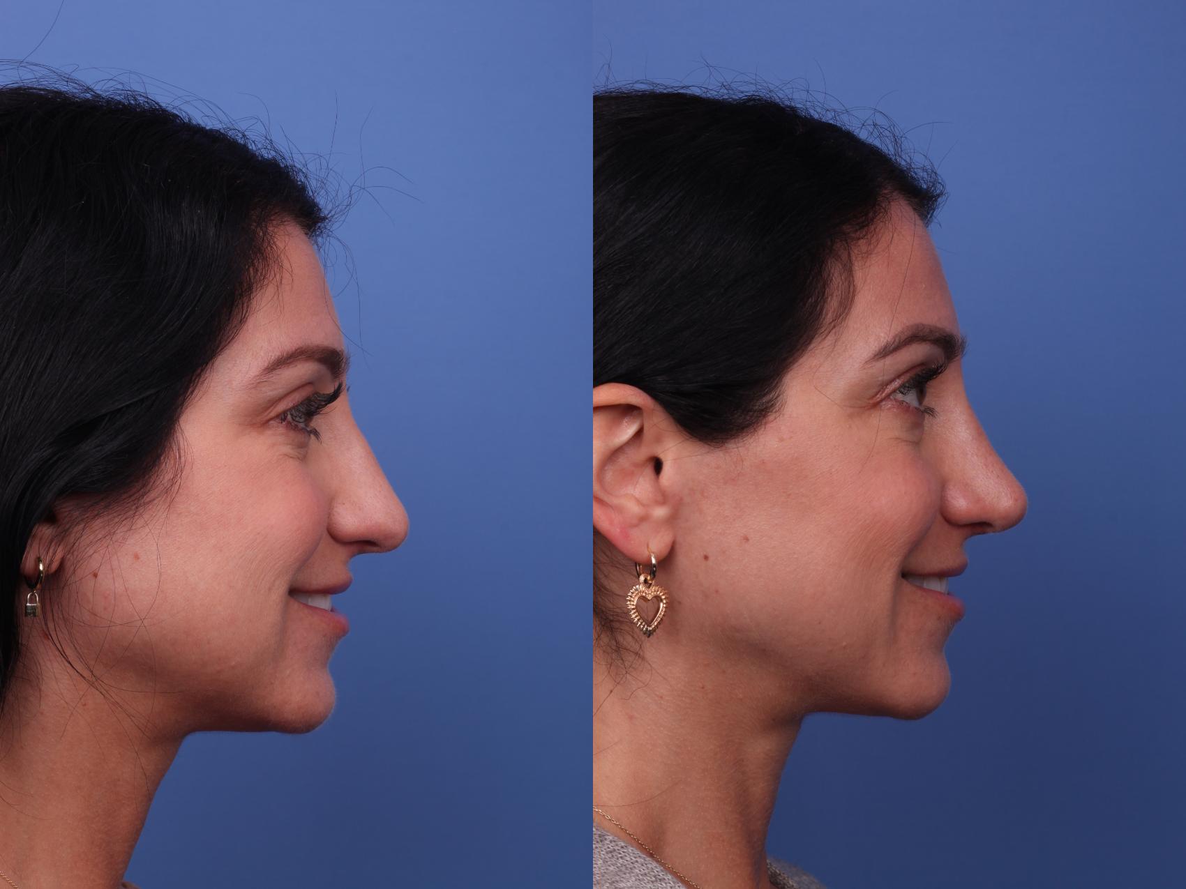 Before & After Rhinoplasty Case 435 Right Smile View in Scottsdale, AZ