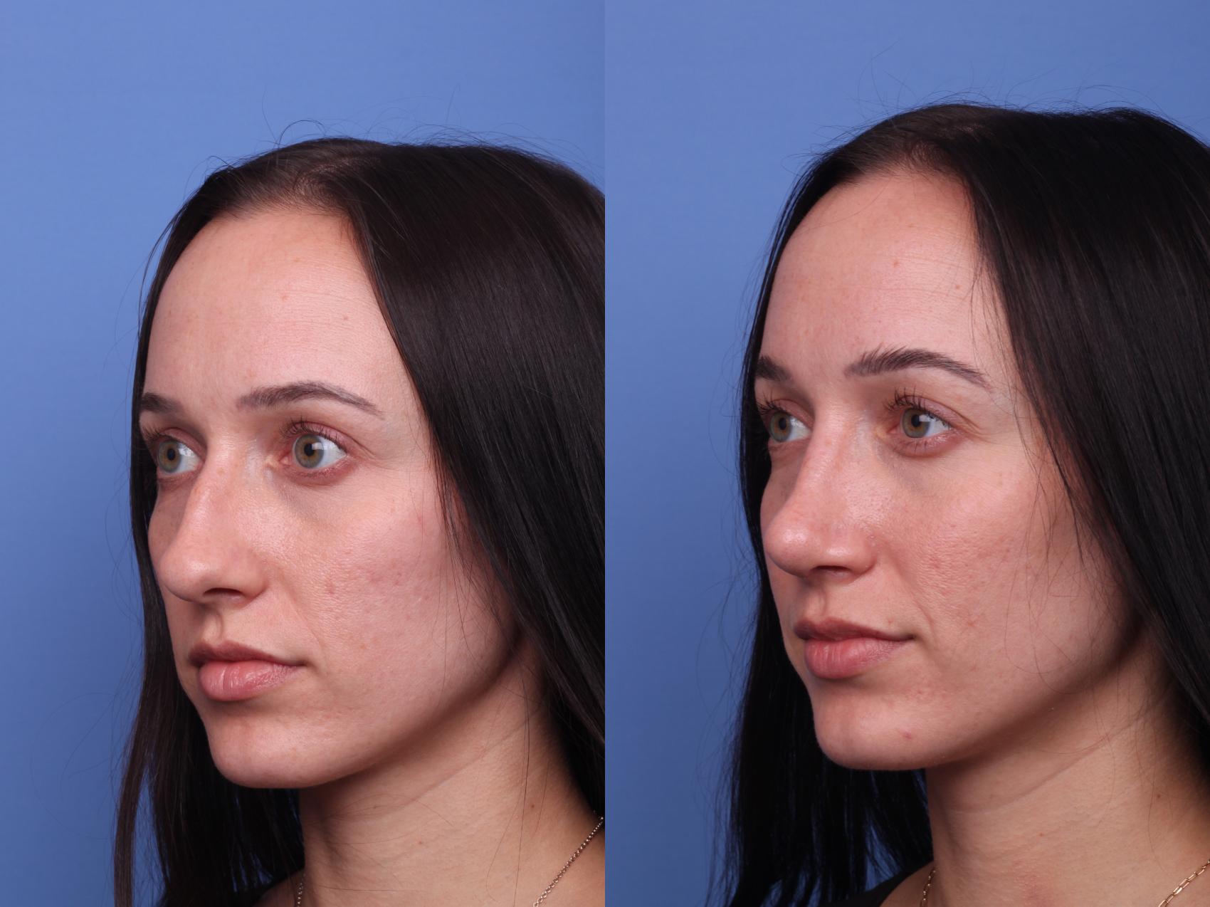 Before & After Rhinoplasty Case 436 Left Oblique View in Scottsdale, AZ