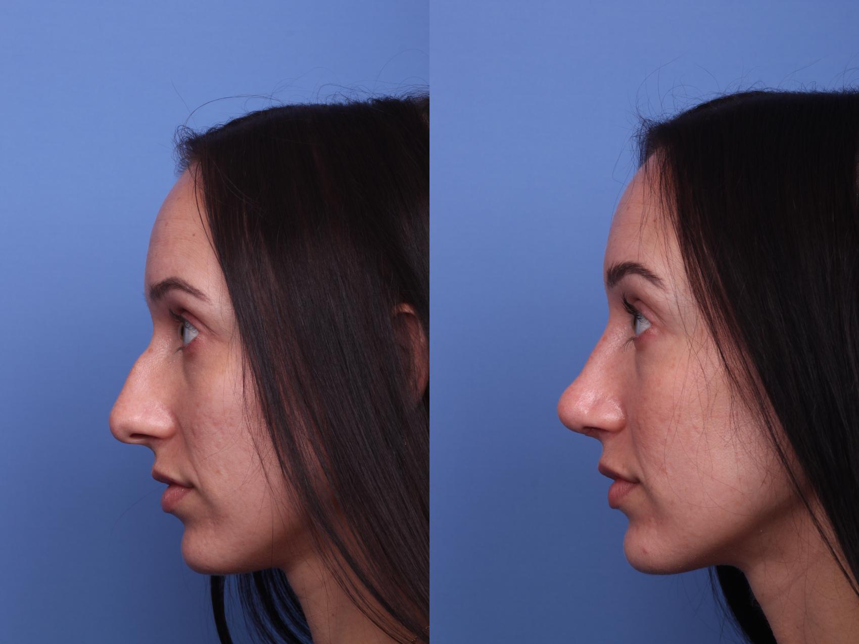 Before & After Rhinoplasty Case 436 Left Side View in Scottsdale, AZ