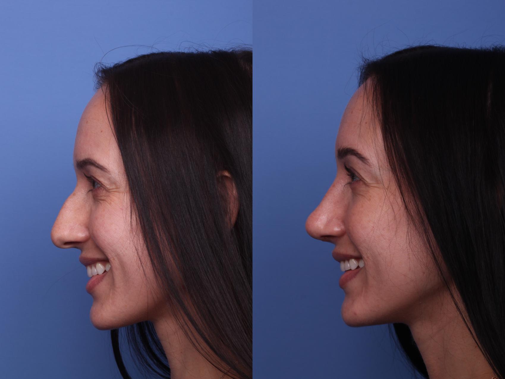 Before & After Rhinoplasty Case 436 Left Smile View in Scottsdale, AZ
