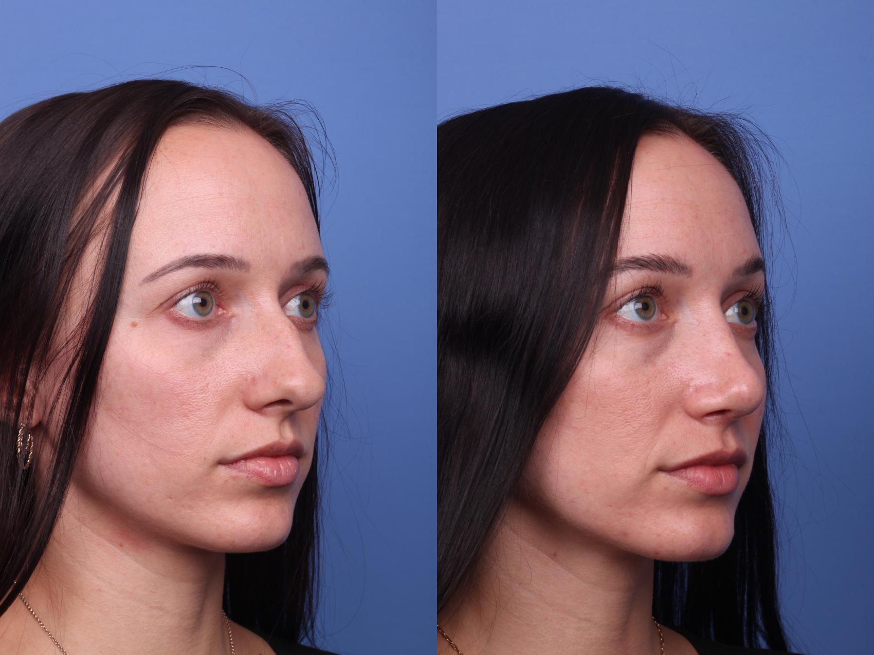 Before & After Rhinoplasty Case 436 Right Oblique View in Scottsdale, AZ