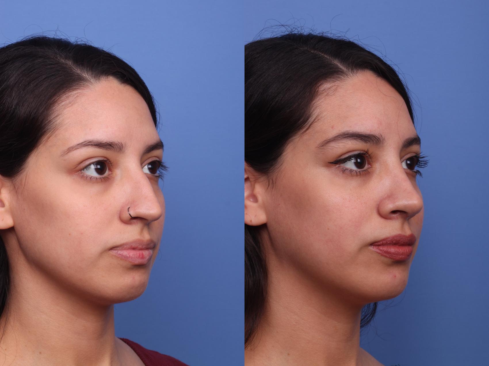 Before & After Rhinoplasty Case 437 Right Oblique View in Scottsdale, AZ