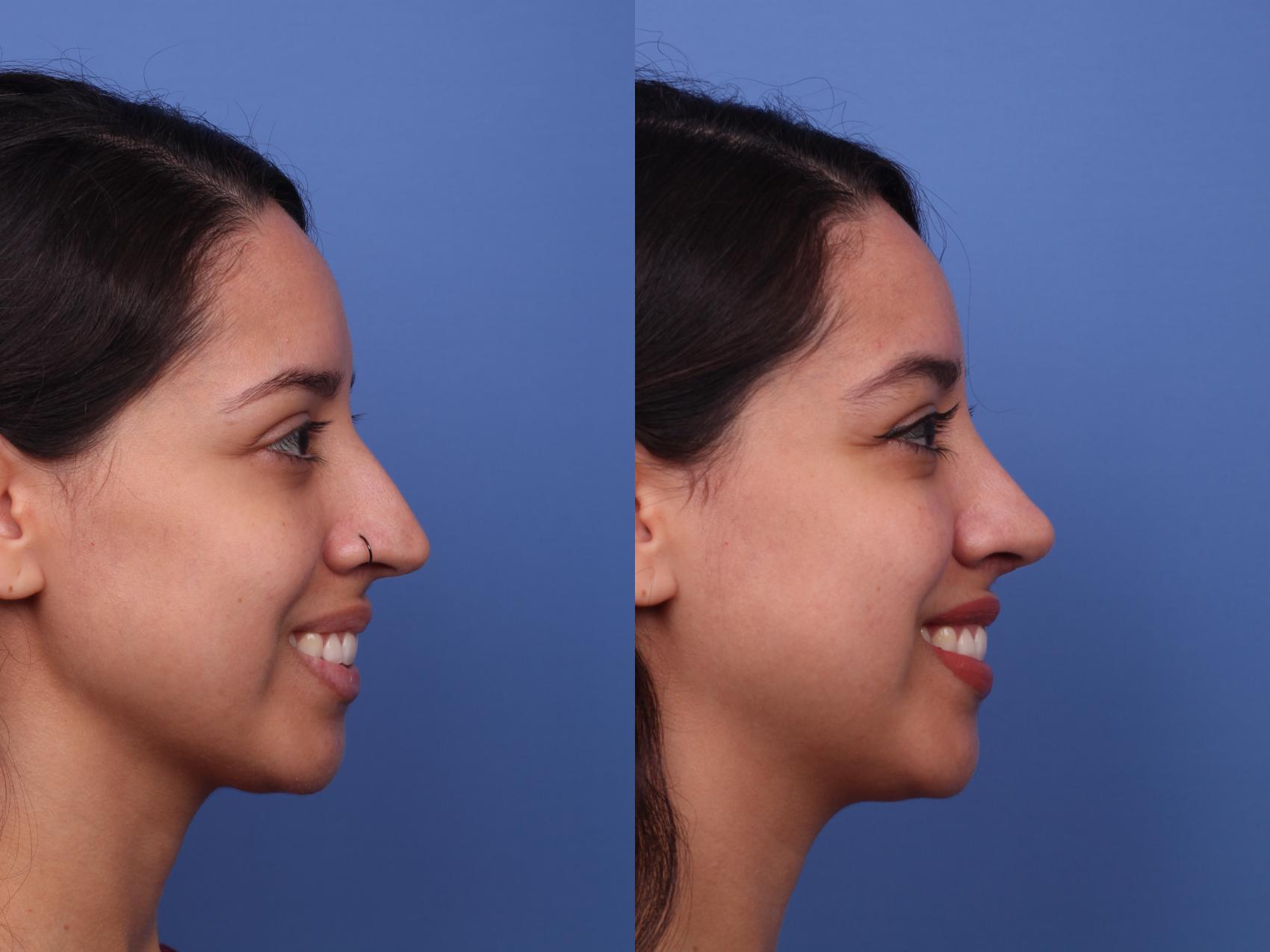 Before & After Rhinoplasty Case 437 Right Smile View in Scottsdale, AZ