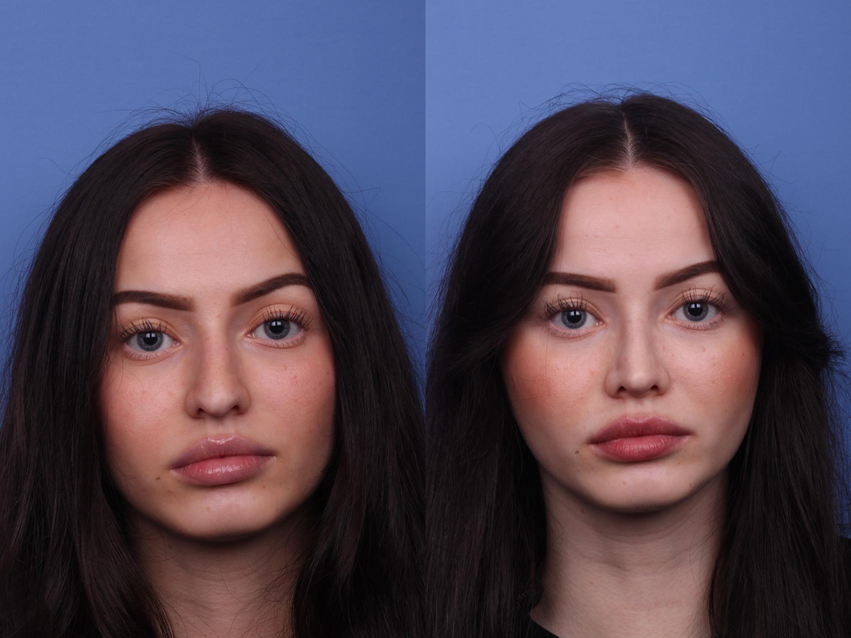 Before & After Rhinoplasty Case 438 Front View in Scottsdale, AZ