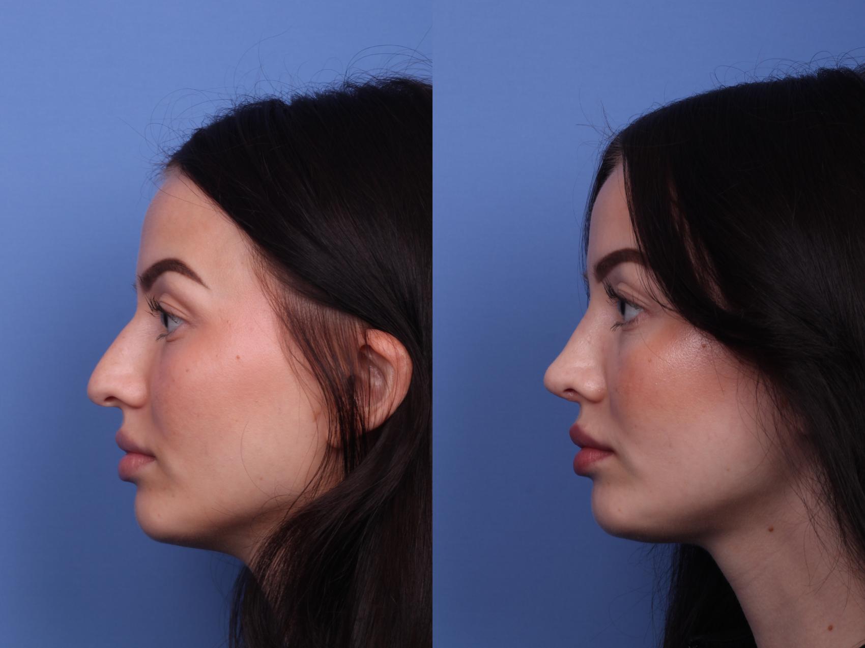 Before & After Rhinoplasty Case 438 Left Side View in Scottsdale, AZ