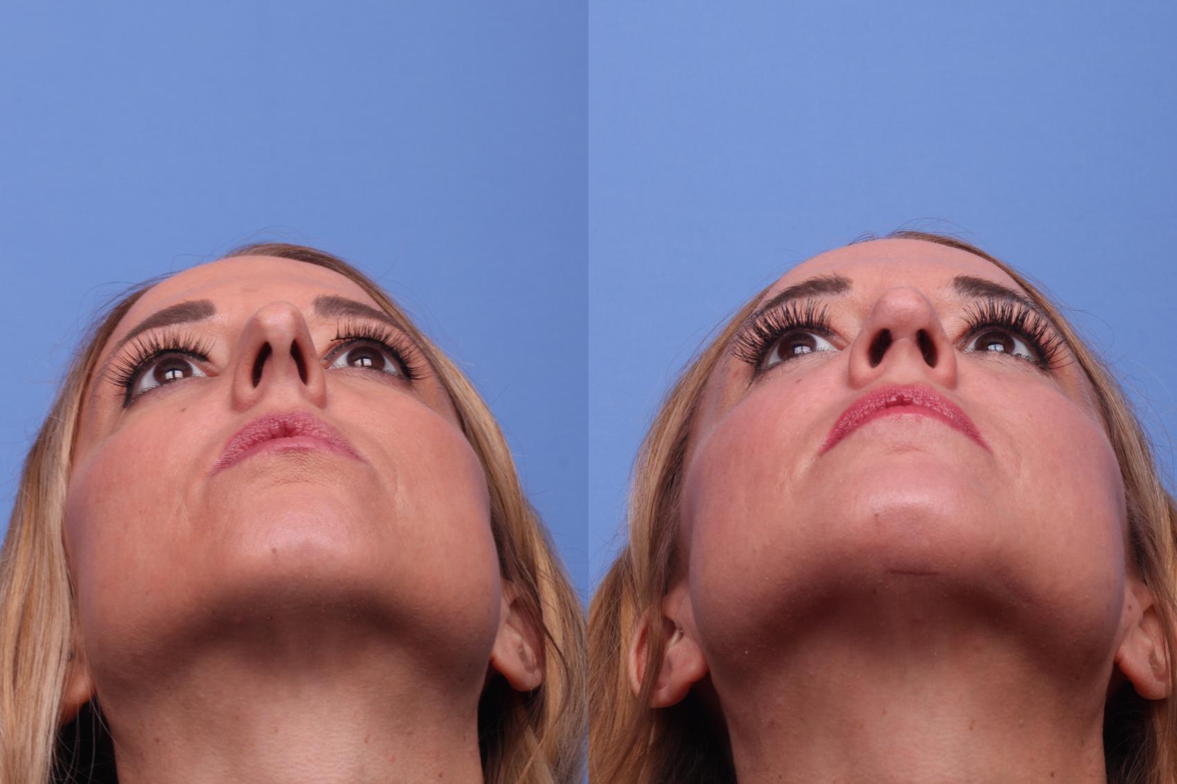Before & After Rhinoplasty Case 439 Base View in Scottsdale, AZ