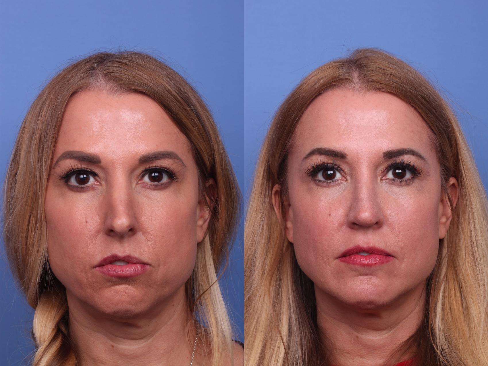 Before & After Rhinoplasty Case 439 Front View in Scottsdale, AZ