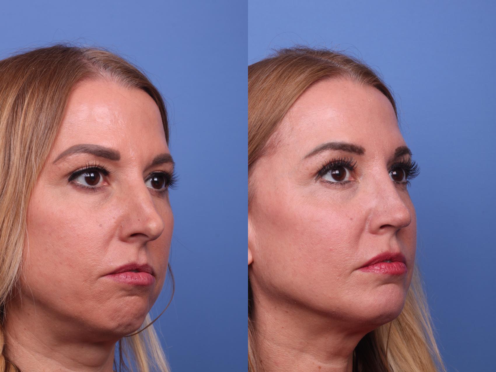 Before & After Rhinoplasty Case 439 Right Oblique View in Scottsdale, AZ