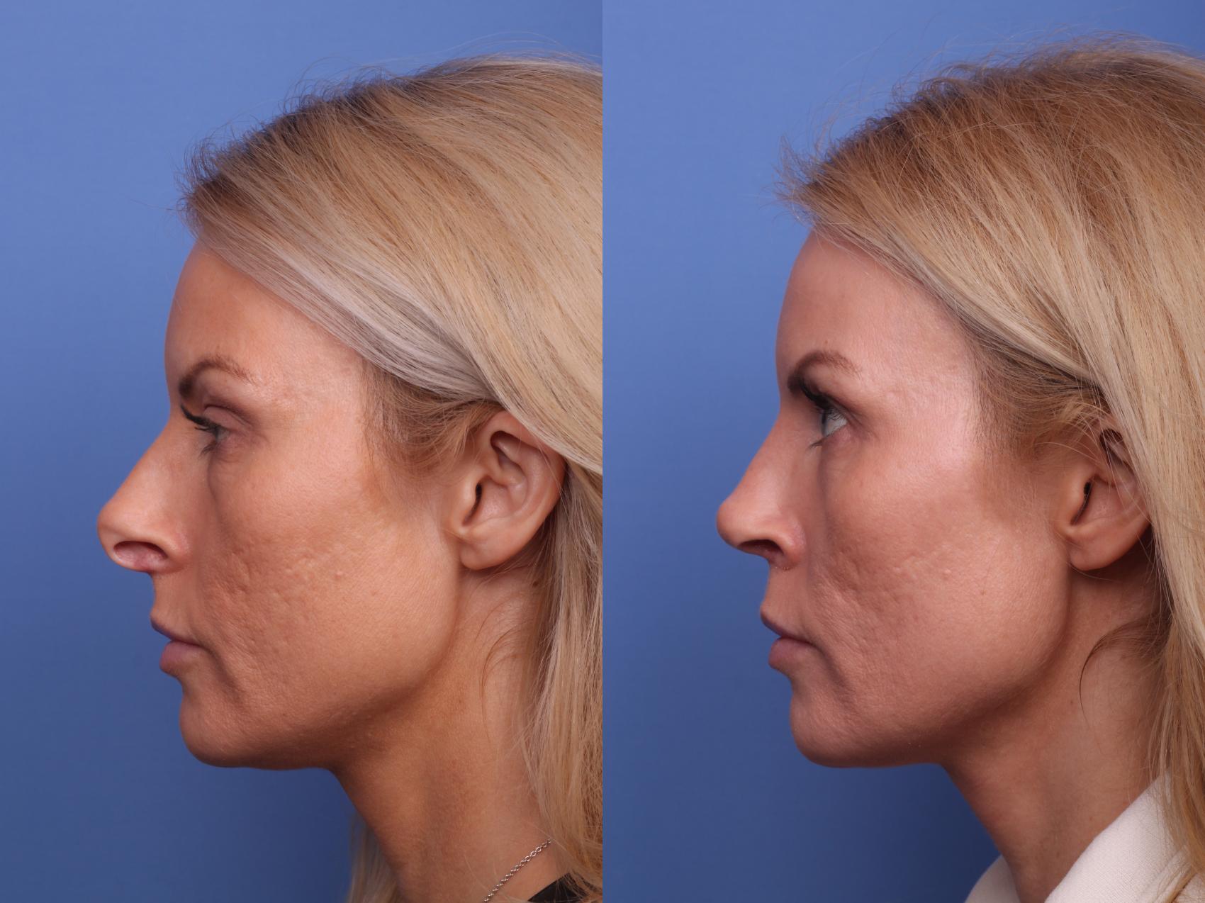 Before & After Rhinoplasty Case 440 Left Side View in Scottsdale, AZ