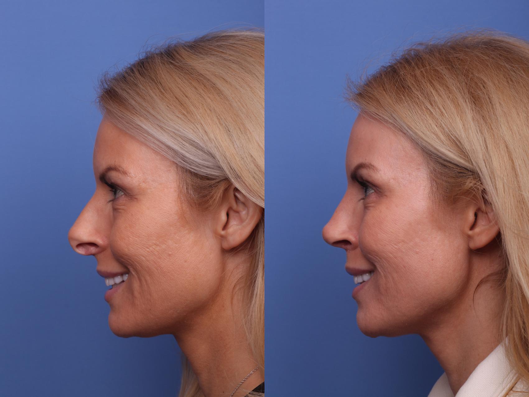 Before & After Rhinoplasty Case 440 Left Smile View in Scottsdale, AZ
