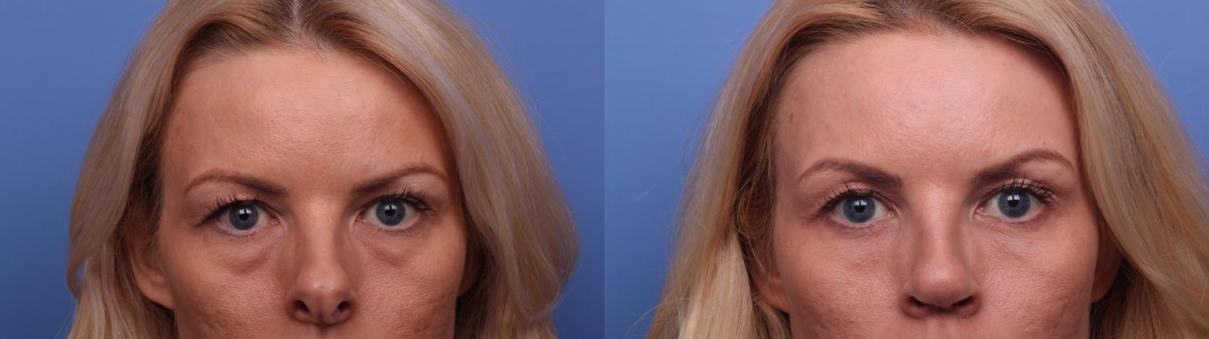 Before & After Rhinoplasty Case 440 Zoom Bleph View in Scottsdale, AZ