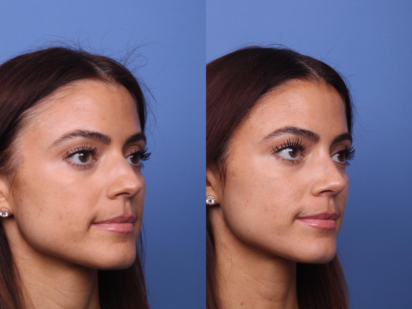 Before & After Rhinoplasty Case 441 Right Oblique View in Scottsdale, AZ