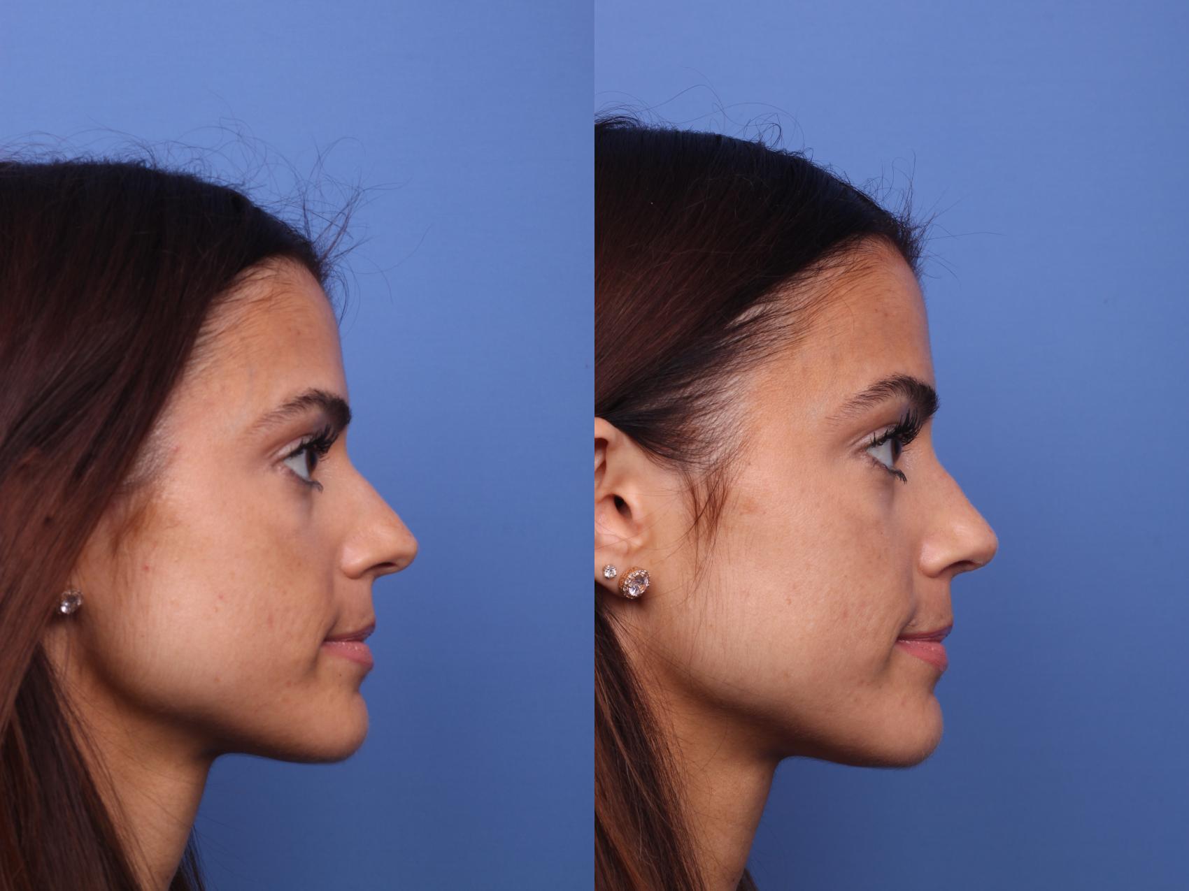 Before & After Rhinoplasty Case 441 Right Side View in Scottsdale, AZ